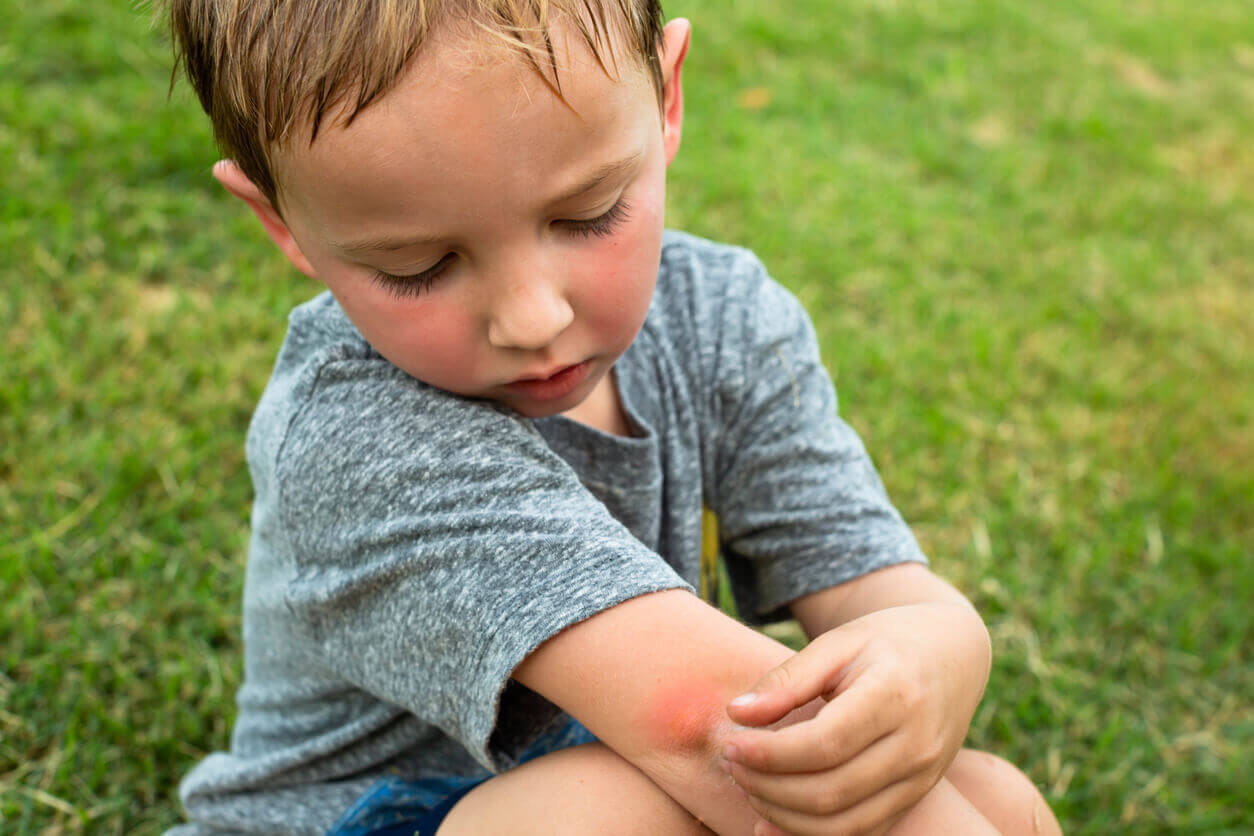 Verão e picadas de inseto em crianças